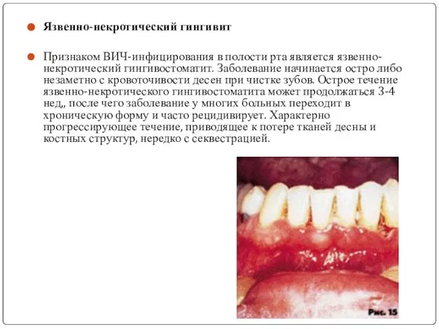 Язвенно-некротический гингивит Признаком ВИЧ-инфицирования в полости рта является язвенно-некротический гингивостоматит. Заболевание