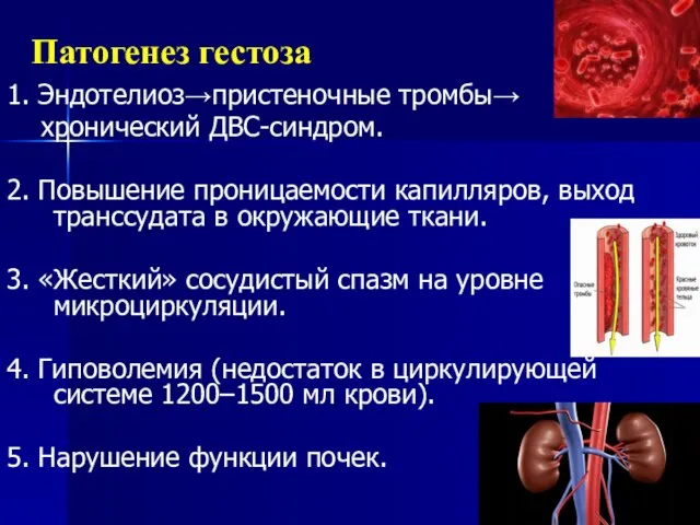 Патогенез гестоза 1. Эндотелиоз→пристеночные тромбы→ хронический ДВС-синдром. 2. Повышение проницаемости капилляров,