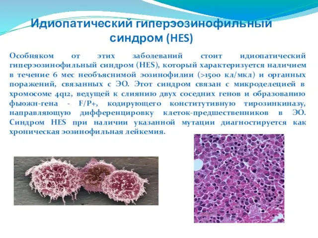 Особняком от этих заболеваний стоит идиопатический гиперэозинофильный синдром (HES), который характеризуется