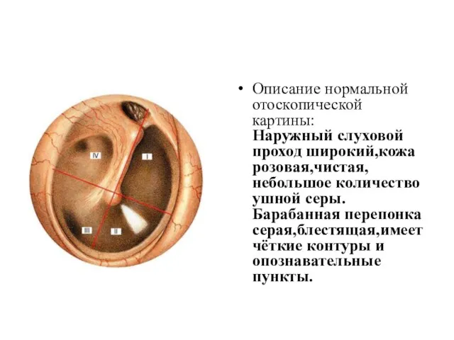 Описание нормальной отоскопической картины: Наружный слуховой проход широкий,кожа розовая,чистая, небольшое количество