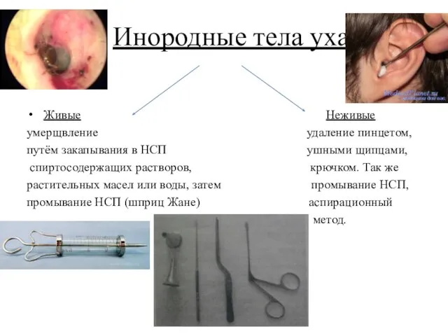 Инородные тела уха Живые Неживые умерщвление удаление пинцетом, путём закапывания в