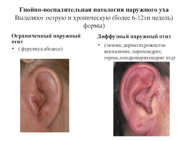 Гнойно-воспалительная патология наружного уха Выделяют острую и хроническую (более 6-12ти недель)