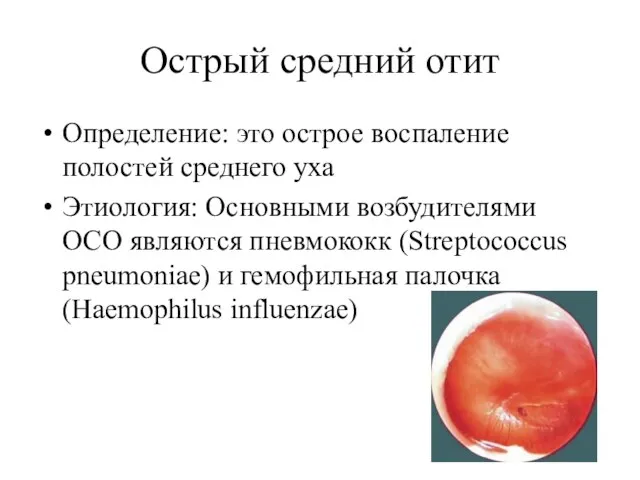 Острый средний отит Определение: это острое воспаление полостей среднего уха Этиология: