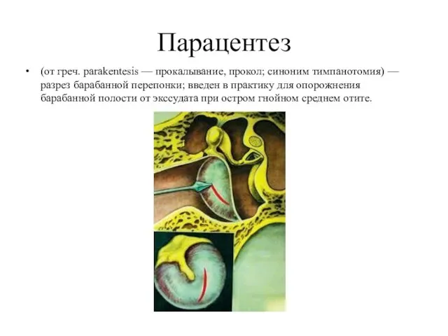 Парацентез (от греч. parakentesis — прокалывание, прокол; синоним тимпанотомия) — разрез