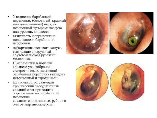 Утолщение барабанной перепонки, (беловатый, красный или цианотичный) цвет, за перепонкой пузырьки