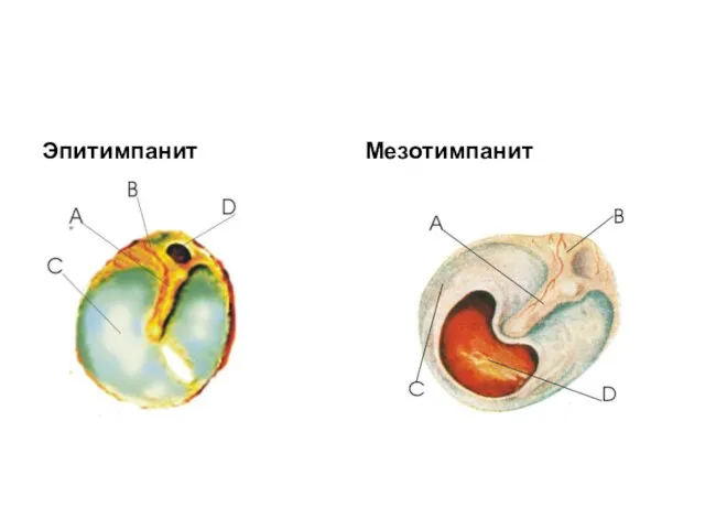 Эпитимпанит Мезотимпанит