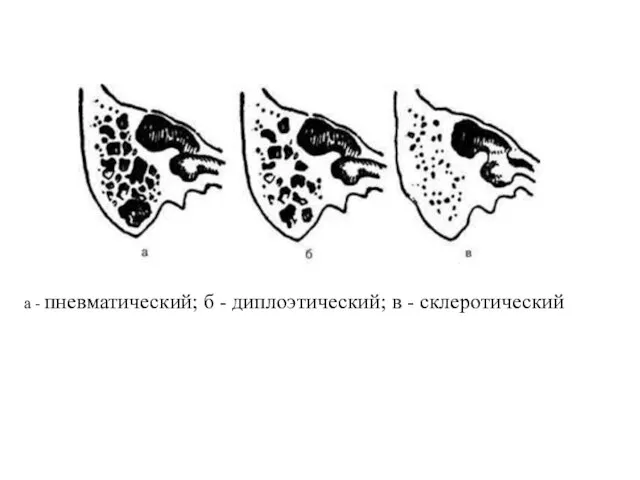 а - пневматический; б - диплоэтический; в - склеротический