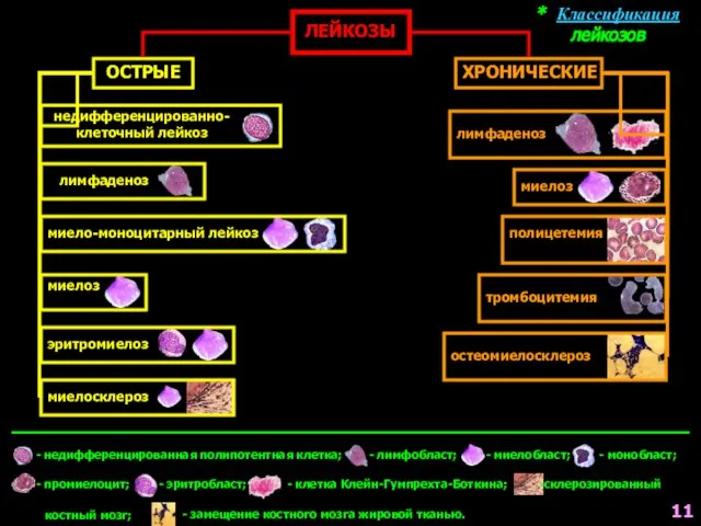 * Классификация лейкозов ЛЕЙКОЗЫ ОСТРЫЕ ХРОНИЧЕСКИЕ недифференцированно- клеточный лейкоз лимфаденоз лимфаденоз