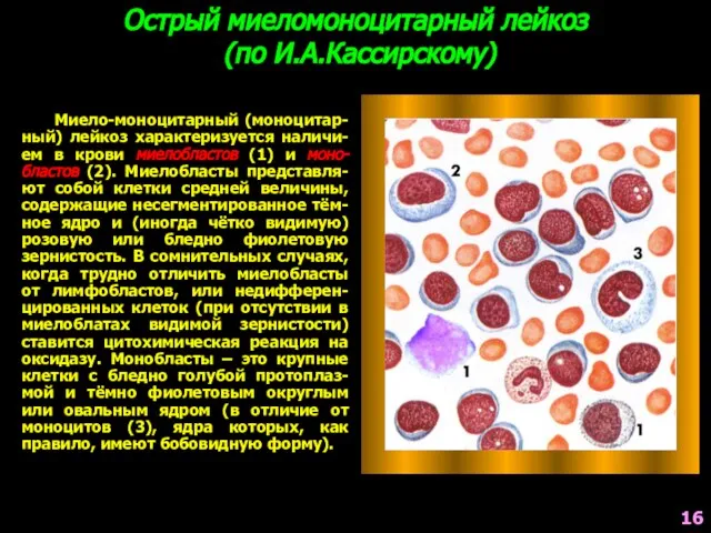 Острый миеломоноцитарный лейкоз (по И.А.Кассирскому) Миело-моноцитарный (моноцитар-ный) лейкоз характеризуется наличи-ем в