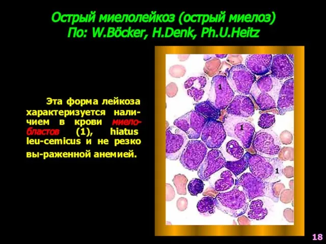 Острый миелолейкоз (острый миелоз) По: W.Böcker, H.Denk, Ph.U.Heitz Эта форма лейкоза