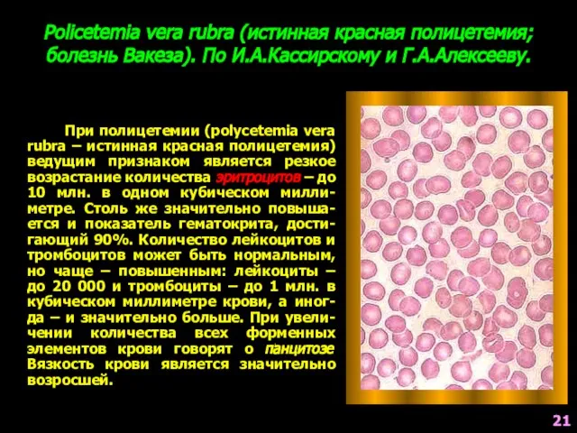 Policetemia vera rubra (истинная красная полицетемия; болезнь Вакеза). По И.А.Кассирскому и