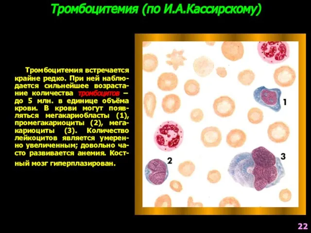 Тромбоцитемия (по И.А.Кассирскому) Тромбоцитемия встречается крайне редко. При ней наблю-дается сильнейшее