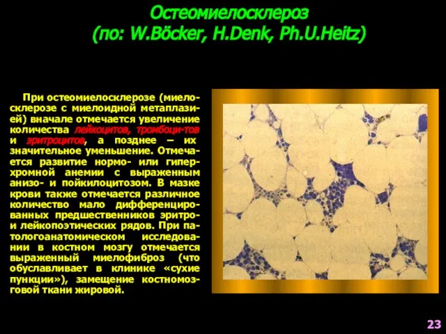 Остеомиелосклероз (по: W.Böcker, H.Denk, Ph.U.Heitz) При остеомиелосклерозе (миело-склерозе с миелоидной метаплази-ей)