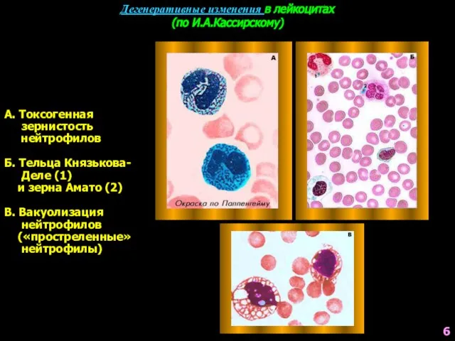 Дегенеративные изменения в лейкоцитах (по И.А.Кассирскому) А. Токсогенная зернистость нейтрофилов Б.