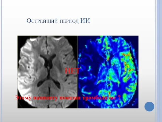 Острейший период ИИ Этому пациенту показан тромболизис ? НЕТ