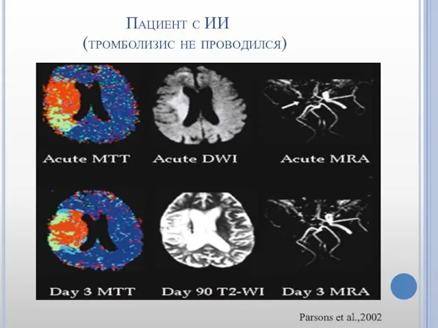Пациент с ИИ (тромболизис не проводился) Parsons et al.,2002