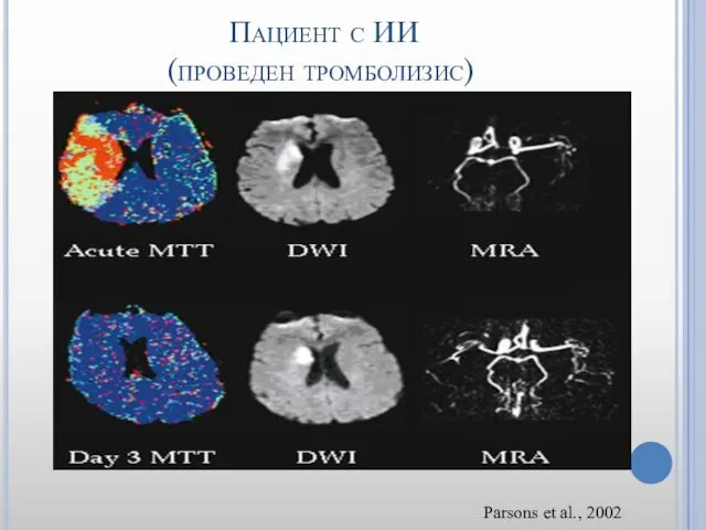 Пациент с ИИ (проведен тромболизис) Parsons et al., 2002