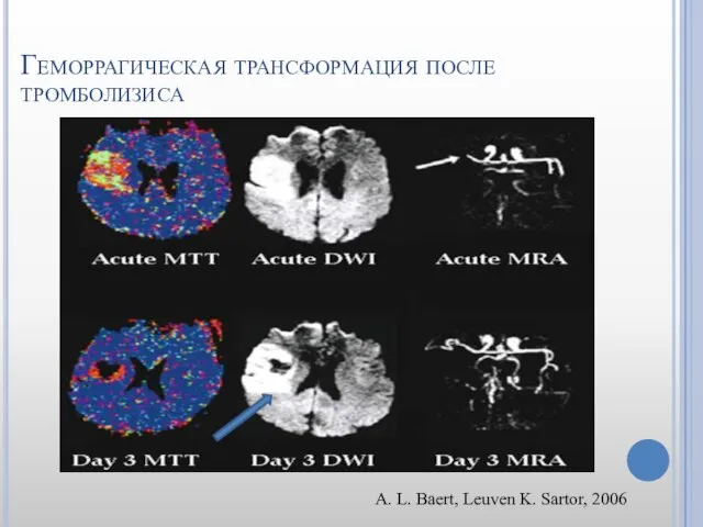 Геморрагическая трансформация после тромболизиса A. L. Baert, Leuven K. Sartor, 2006