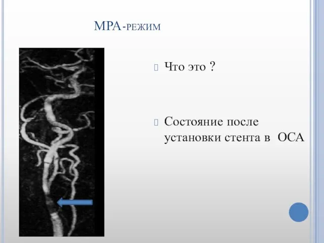 МРА-режим Что это ? Состояние после установки стента в ОСА