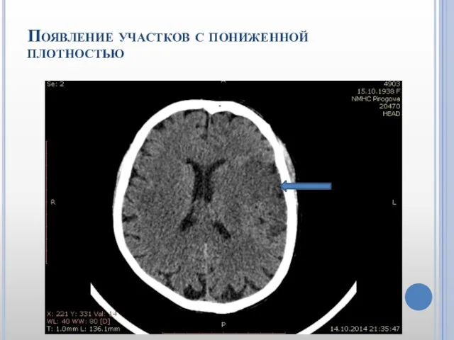 Появление участков с пониженной плотностью