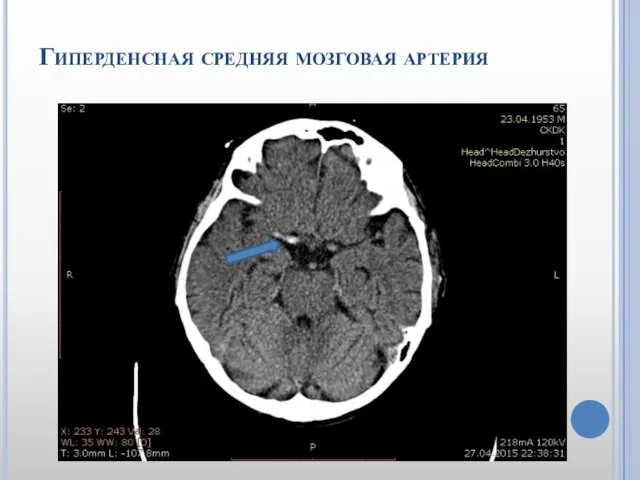 Гиперденсная средняя мозговая артерия