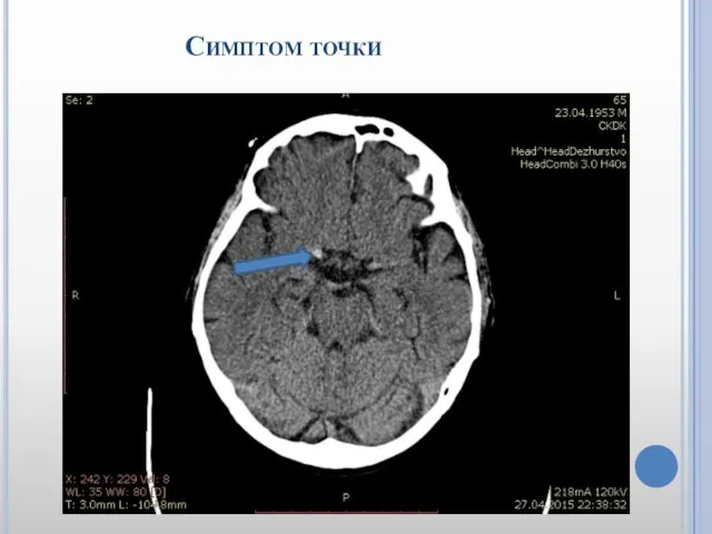 Симптом точки