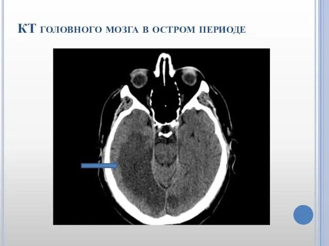 КТ головного мозга в остром периоде