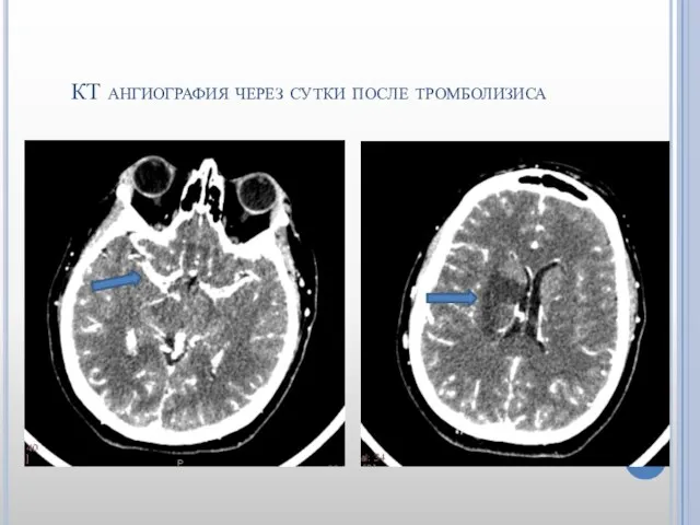 КТ ангиография через сутки после тромболизиса