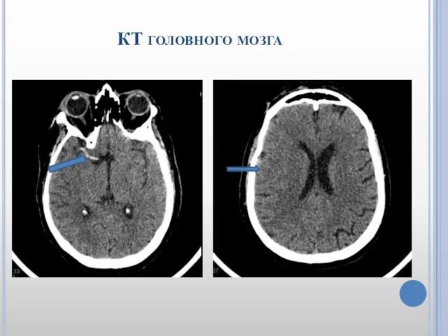 КТ головного мозга