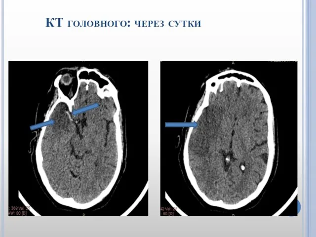 КТ головного: через сутки