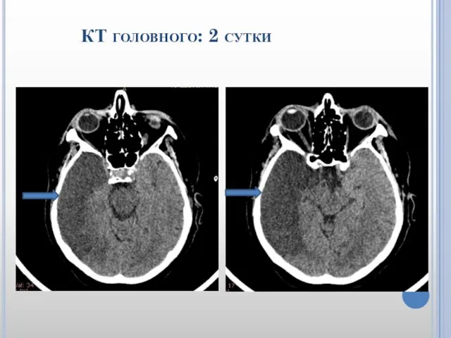 КТ головного: 2 сутки