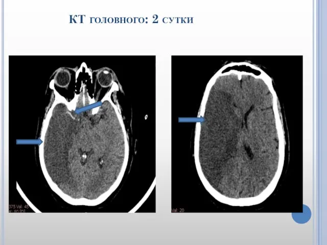 КТ головного: 2 сутки