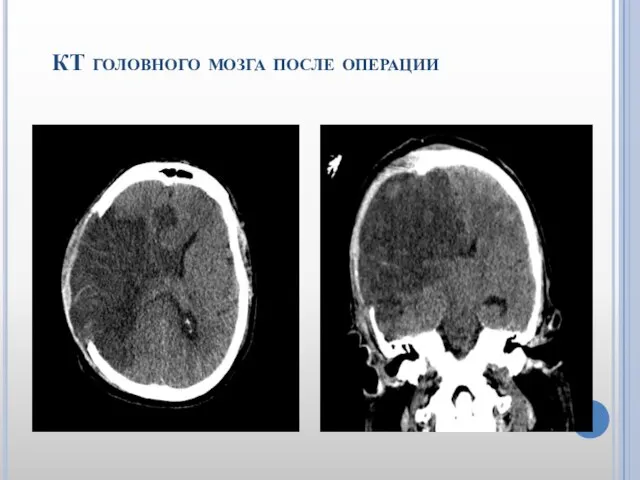 КТ головного мозга после операции