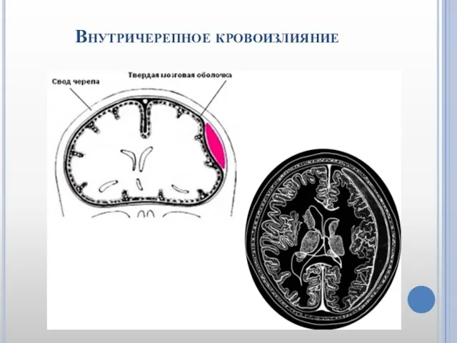 Внутричерепное кровоизлияние