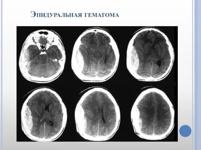 Эпидуральная гематома