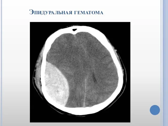 Эпидуральная гематома