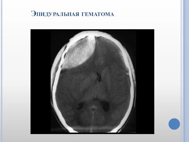 Эпидуральная гематома