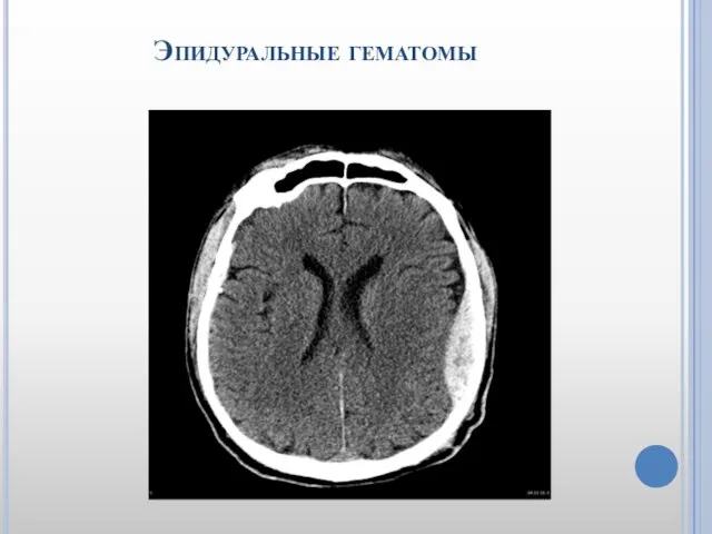 Эпидуральные гематомы
