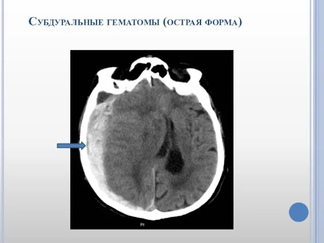 Субдуральные гематомы (острая форма)