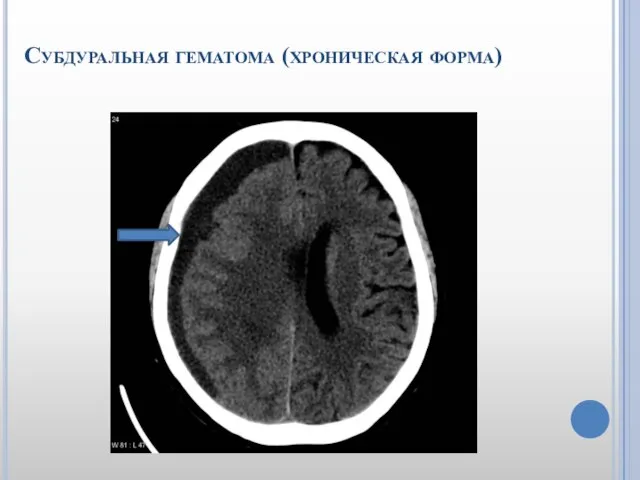 Субдуральная гематома (хроническая форма)