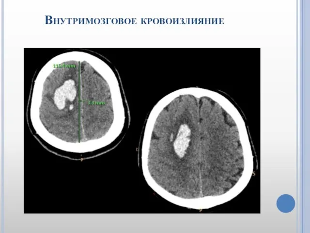 Внутримозговое кровоизлияние