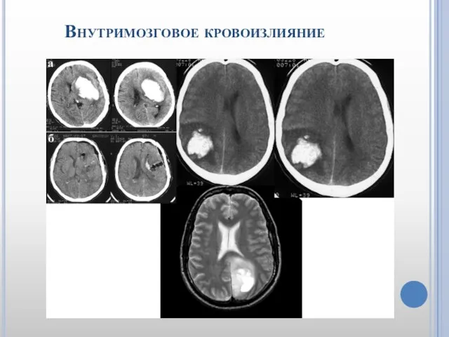 Внутримозговое кровоизлияние