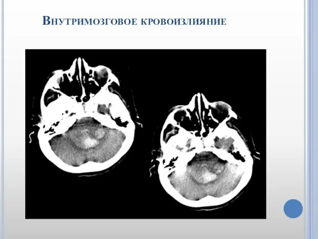 Внутримозговое кровоизлияние