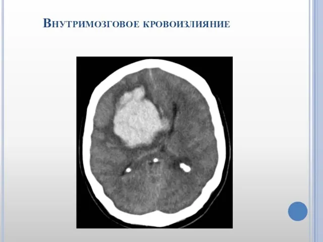 Внутримозговое кровоизлияние