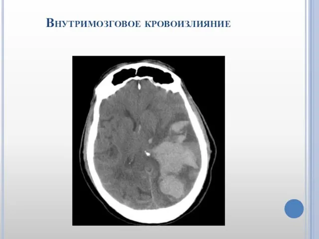 Внутримозговое кровоизлияние