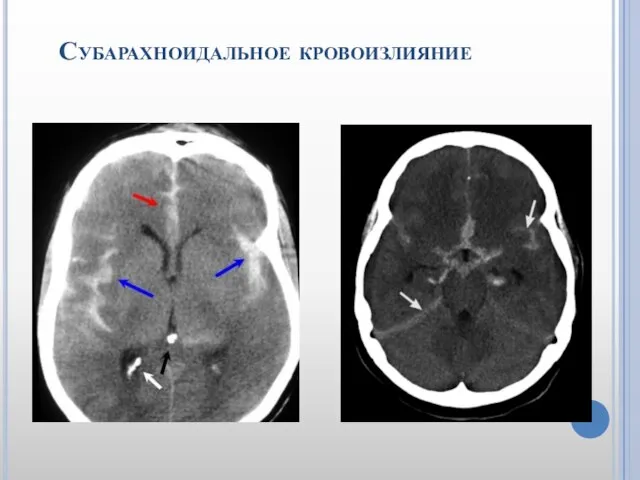 Субарахноидальное кровоизлияние