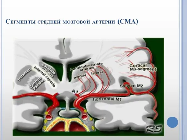 Сегменты средней мозговой артерии (СМА)