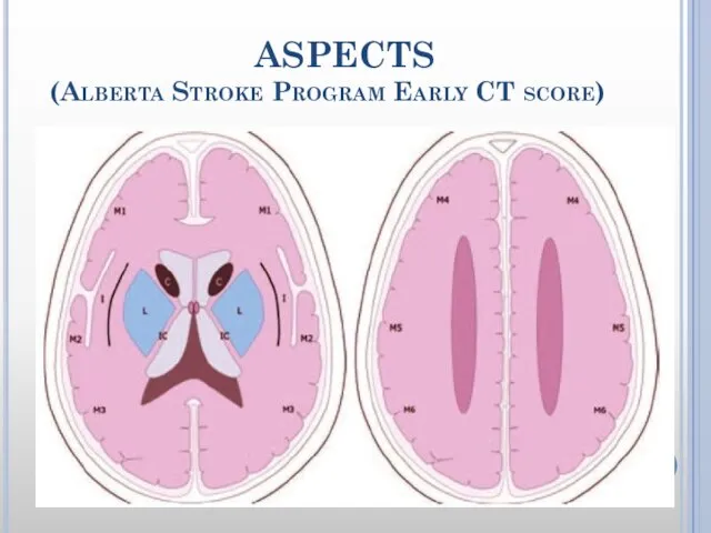 ASPECTS (Alberta Stroke Program Early CT score)