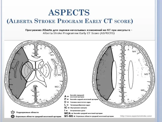 ASPECTS (Alberta Stroke Program Early CT score)