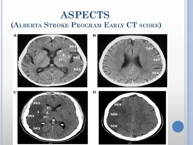 ASPECTS (Alberta Stroke Program Early CT score)